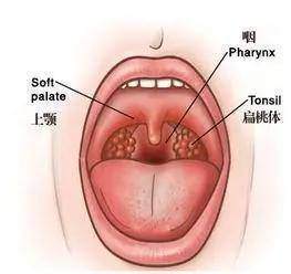 贵阳铭仁耳鼻喉医院:正确认识慢性咽炎!