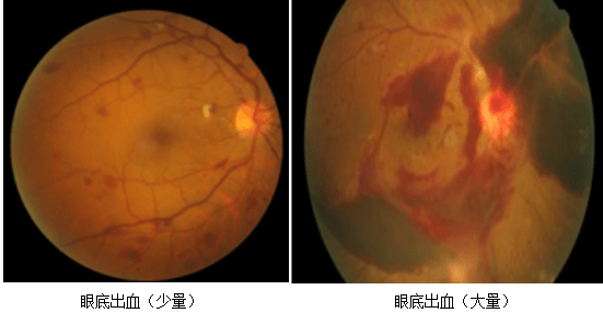 眼底出血到底是怎么回事?上海眼科医生提醒:这四类人群需要格外注意!