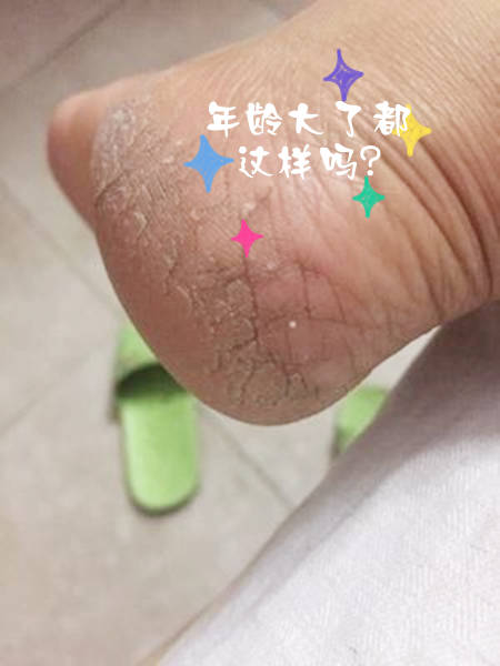 【医生回答】皲裂,这种情况大多见于手脚等局部的皮肤.