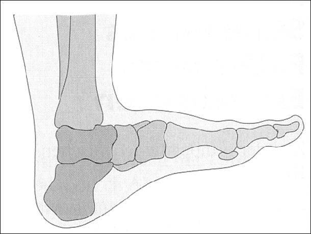 1,外翻足:足不同程度的旋前,外翻,体重压在内侧纵弓和横弓上,并使