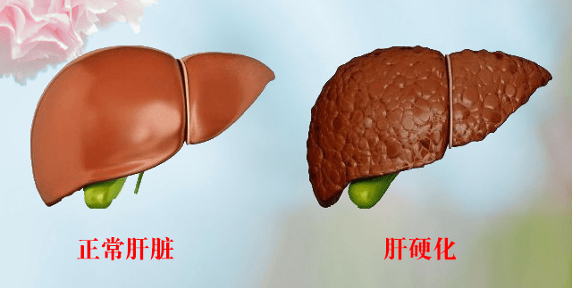 乙肝肝硬化能治愈吗?