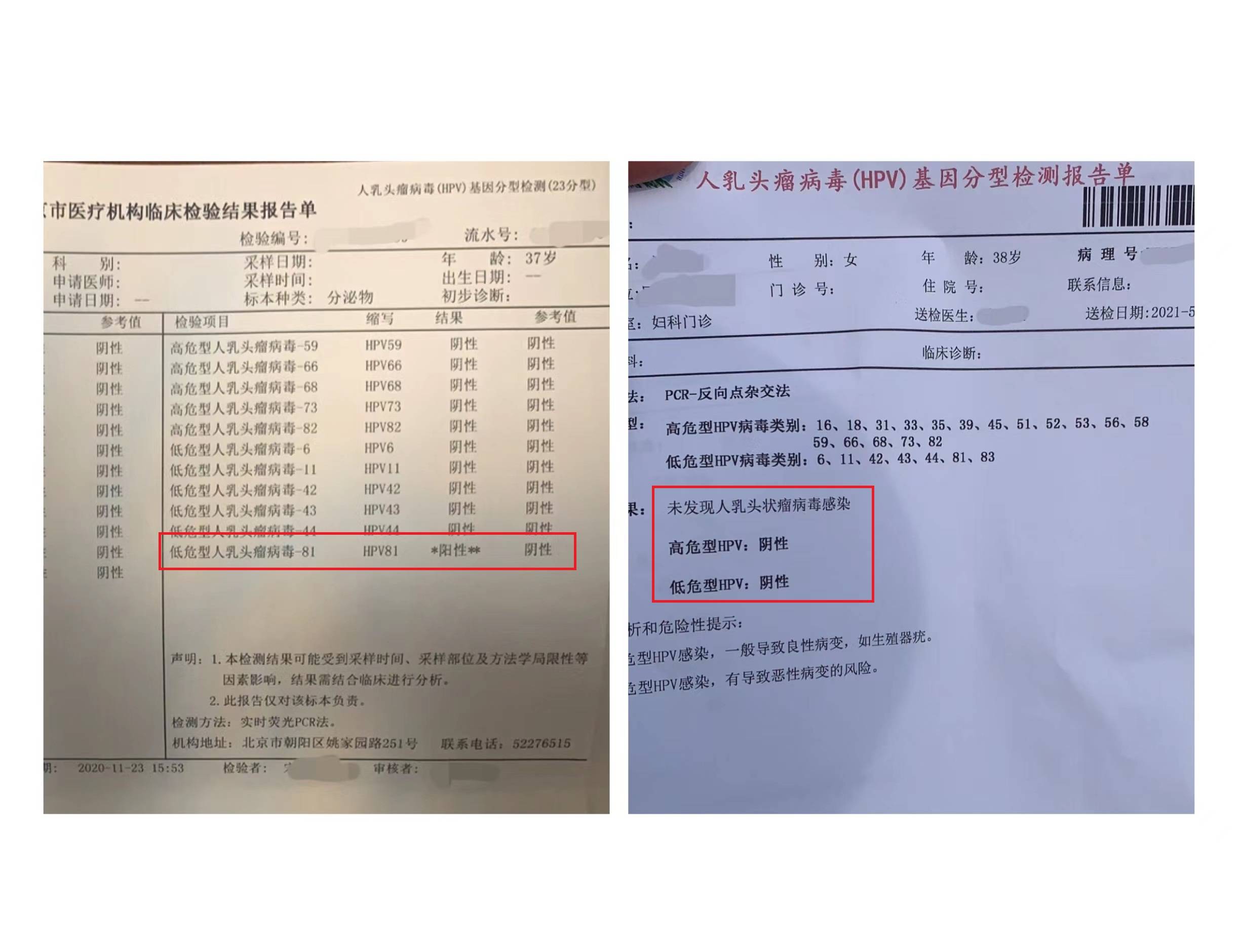 初诊时自述:真菌感染霉菌性阴道炎症反复3年,hpv-81阳性