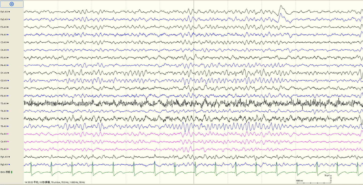 糖糖术后复查头皮脑电图背景,9~10hzα节律糖糖术前清醒期间期,双侧全