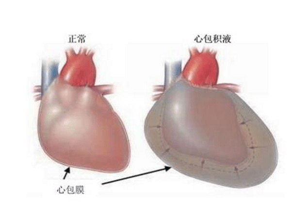 足,身体代谢降低,心脏器官代谢也随着降低,这时心包膜血管通透性增加