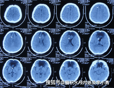 图-35:2021年5月14日头颅ct2021年5月24日(李小勇脑脊液科治疗3个月)