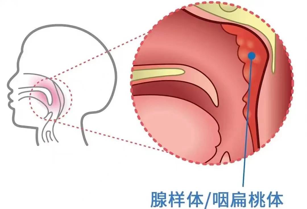 2 腺样体肥大的原因腺样体与腭扁桃体,舌扁桃体 咽鼓管扁桃体,咽侧索