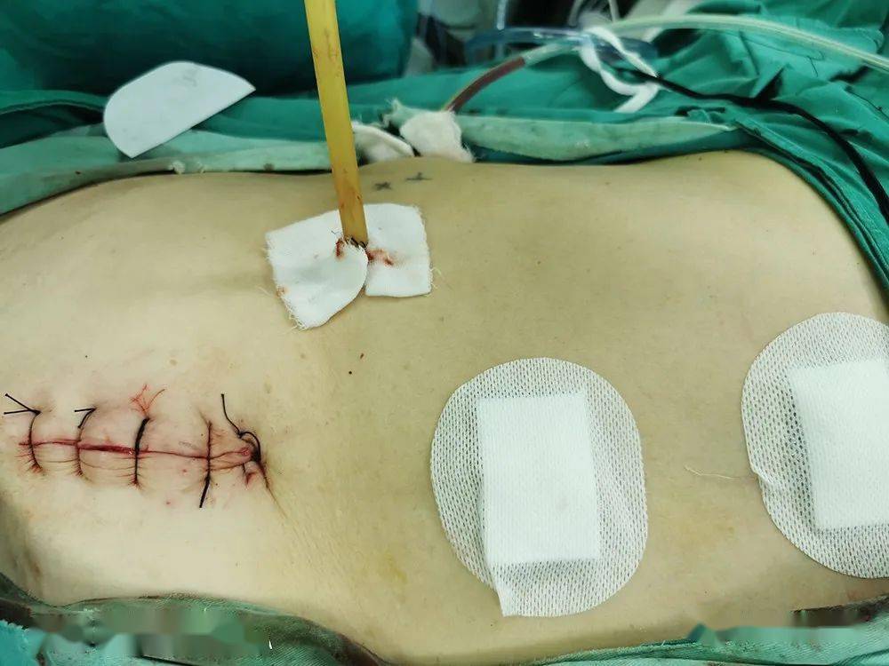 腹腔镜肝切除术——单县东大医院新技术巡礼之肝胆外科篇