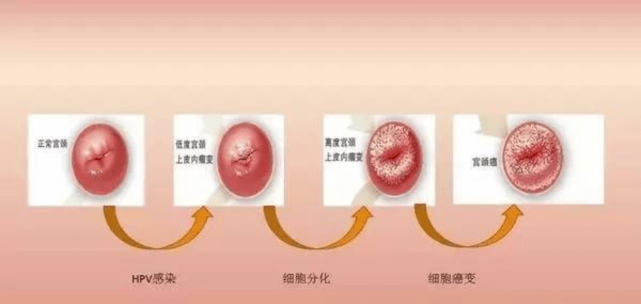 宫颈癌是怎么引起的有4类女性属于高危人群