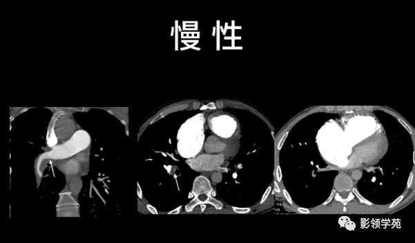 肺栓塞的影像诊断与鉴别诊断