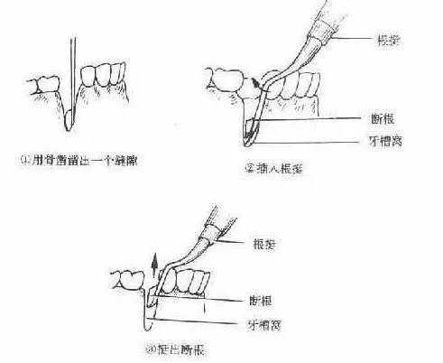 牙挺的类别,基本使用方法及注意事项_手机搜狐网