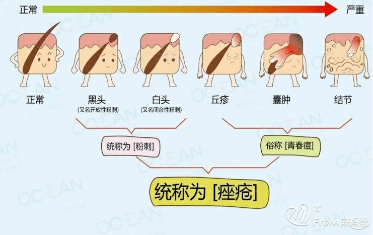 痤疮,俗称"青春痘",是一种发生于毛囊皮脂腺的慢性炎症性皮肤病,主要