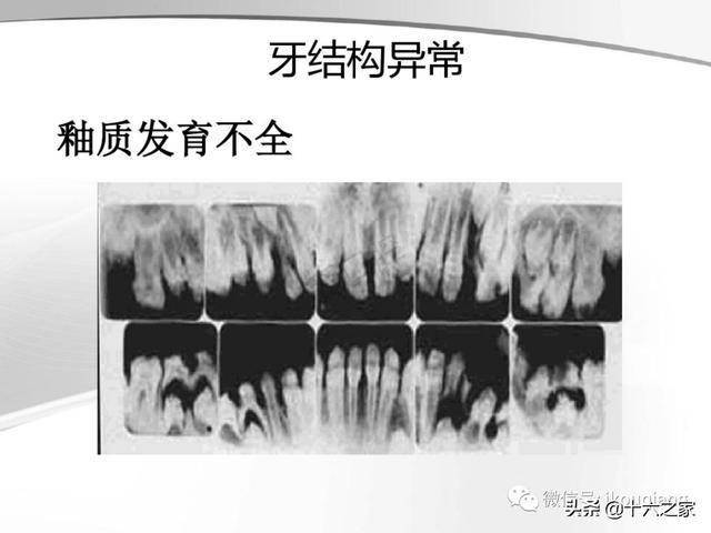 牙及牙周各种疾病影像学表现整理