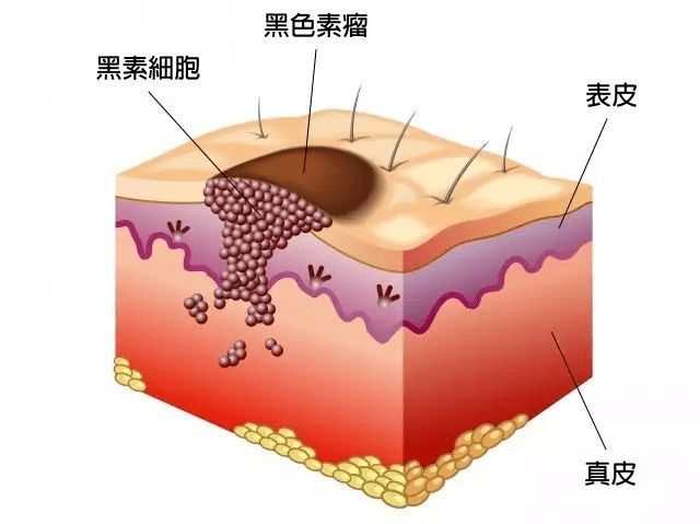 恶性黑色素瘤到底有多可怕?