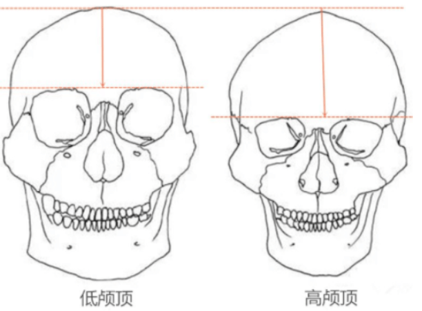 而低颅顶则被看做是颜值bug.