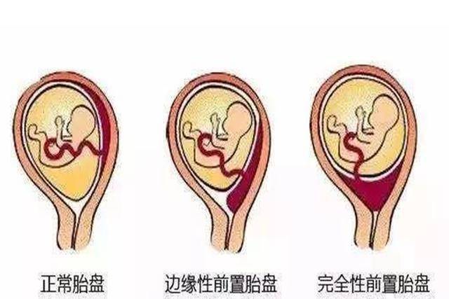 所以一般"胎盘前置"的产妇,医生都会建议选择  剖腹产.