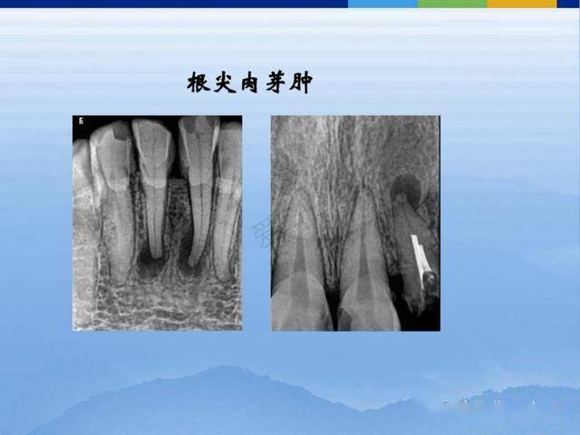 牙体牙周正常解剖及常见病x线表现