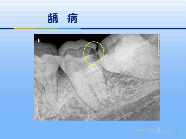 牙体牙周正常解剖及常见病x线表现