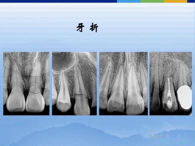 牙体牙周正常解剖及常见病x线表现