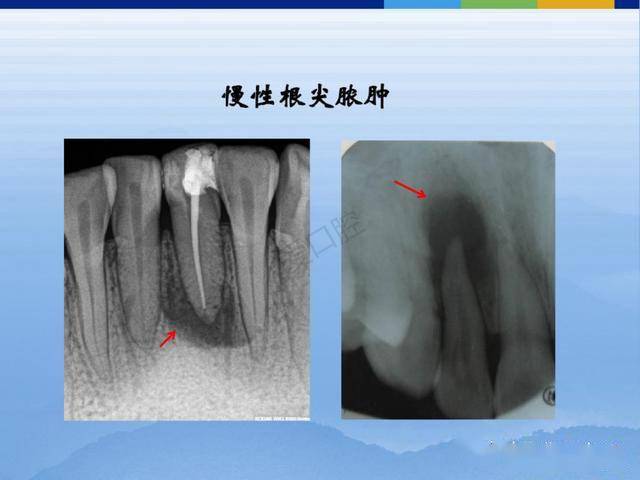 牙体牙周正常解剖及常见病x线表现