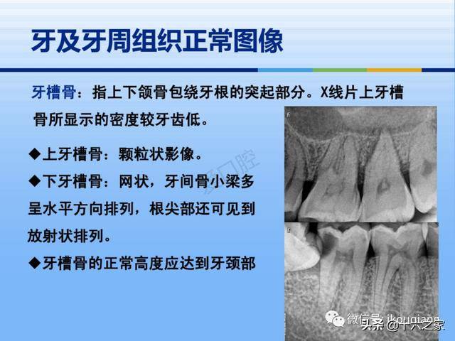 牙体牙周正常解剖及常见病x线表现
