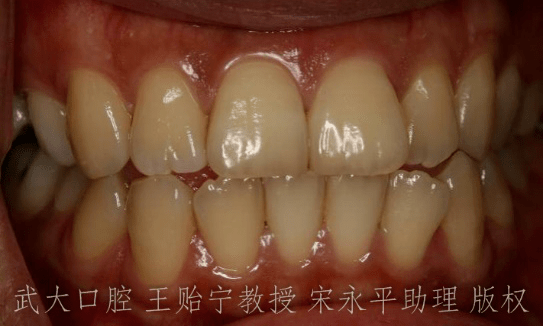例如,增龄性黄牙及先天性黄牙一般只需花费3-6周,即可达到最亮白的