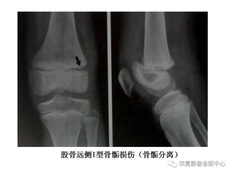 影像基础儿童骨骺损伤影像学分型