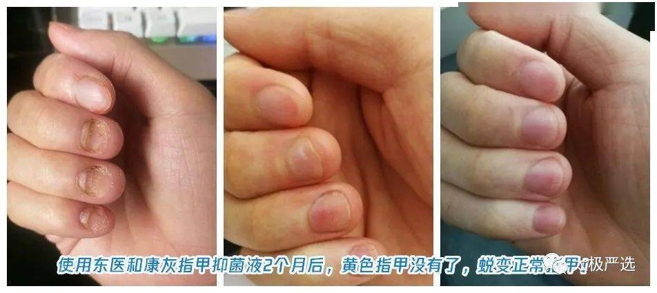 坚持使用东医和康灰指甲抑菌液一段时间后,灰指甲消失恢复健康如初