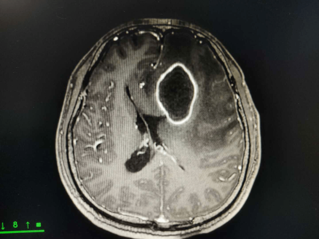 左额叶深部中线旁可见体积较大的脑脓肿,并周围大片脑水肿,颅内压明显