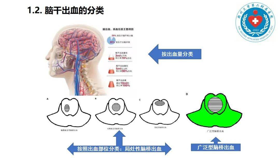 神经导航下无框架立体定向穿刺引流治疗脑干出血