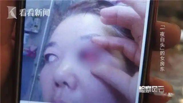 祁选斌|只因一个不小心……提醒所有人!48岁女子一夜白头