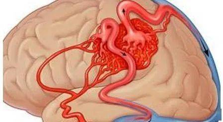 什么是动脉瘤的症状 054a5ecb432c45538f446ff71cecbd9e.jpeg