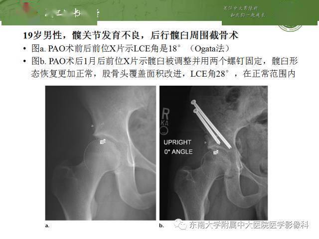髋关节术后(没有置换)的片子,我们怎么看?