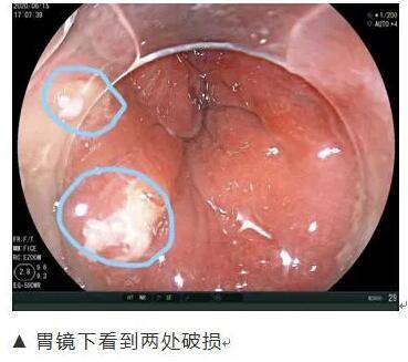 医生|男子食堂吃饭吞下2.5厘米金属针！如鲠在喉却找不到......