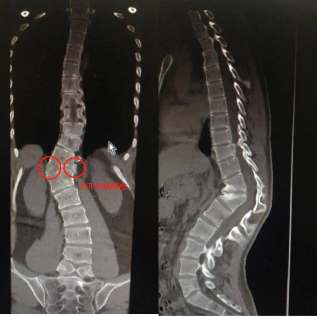 钟志宏指出, 先天性脊柱后凸畸形的发病率比先天性脊柱侧凸要低,但如