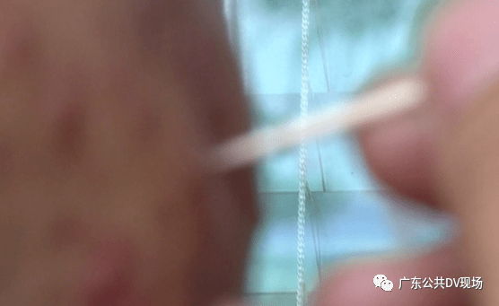 可能导致细菌入脑,引起脑脓肿"这个不好的习惯他就会用牙签把粉刺戳