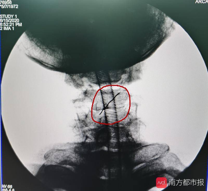 医生|深圳男子单位食堂吃饭，居然误吞“隐形针“，引来八科室医生会诊