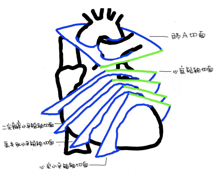 心尖图文详解 | 心超切面不会打？看这一篇就够了！