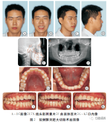 双侧髁突肥大术后的正畸治疗1例