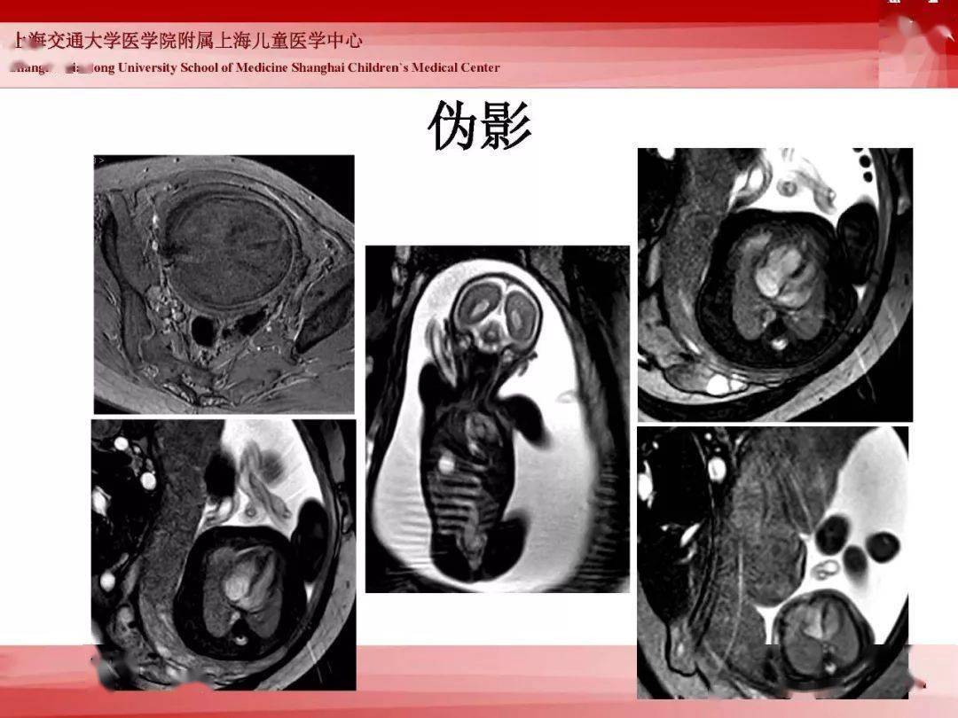 胎儿磁共振的检查技术
