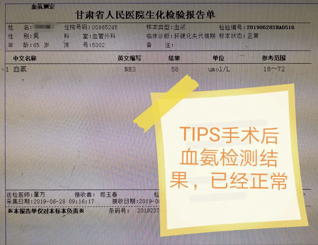 西北专栏董方甘肃省人民医院血管外科改良tips手术微创治疗肝硬化失