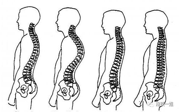 骨盆后倾的情况下,腰椎曲度变直,身体为了维持平衡,胸椎曲度会变大