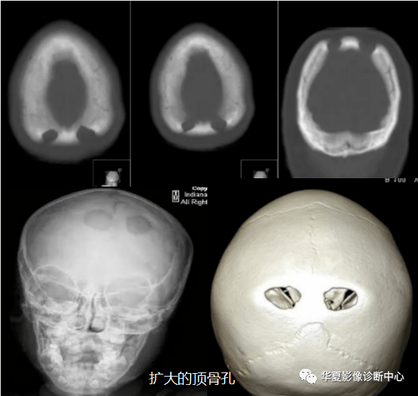 但其大小可不对称,多位于矢状缝两旁,顶骨结节的内侧,距人字缝约2