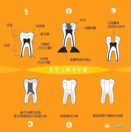 补牙不做冠疗效少一半根管治疗后牙齿已经不疼了为什么还要戴牙冠呢