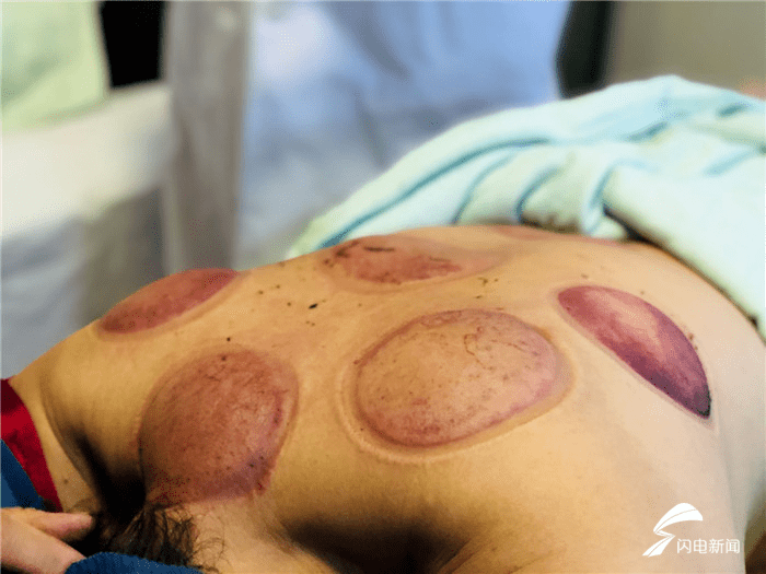 潍坊市|火罐疗法入选潍坊市第六批市级非物质文化遗产代表性项目名录