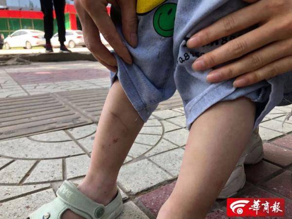 西安2岁半孩子被狗扑倒狗主人远远问了一句后离开回家后发现娃腿被狗咬伤