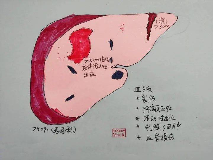 画图aast肝脏破裂伤的分级