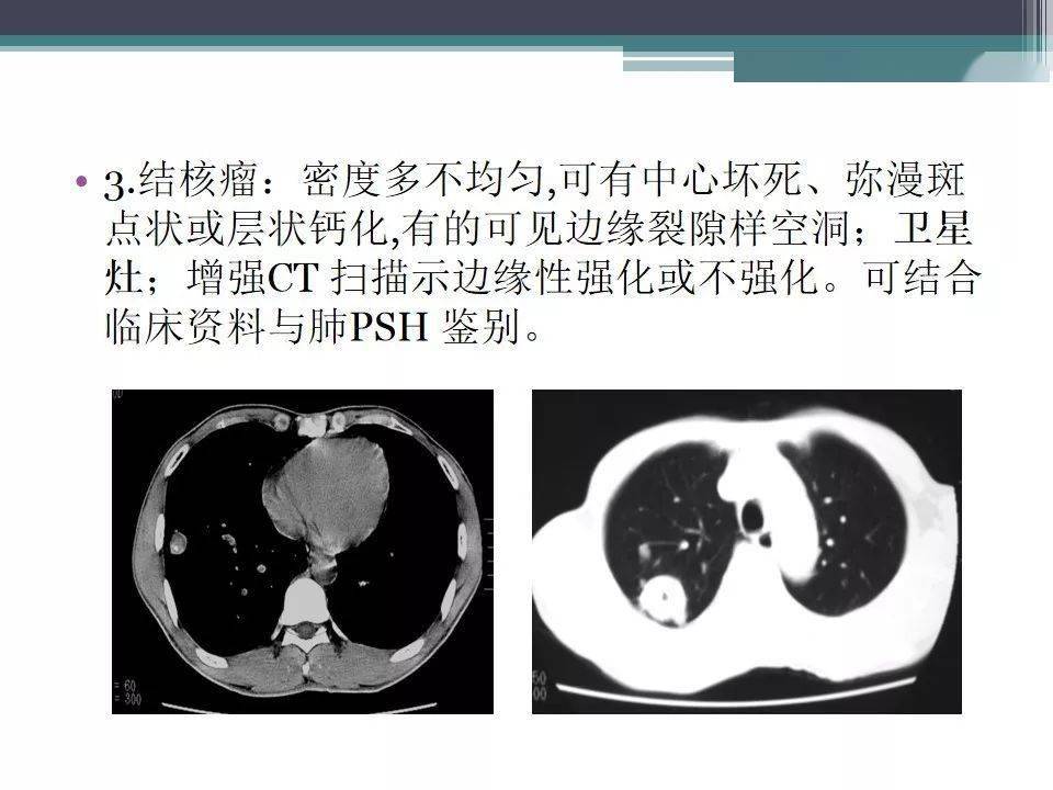 本院ct示:左肺下叶后基底段软组织肿块,考虑周围型肺癌,必要时穿刺