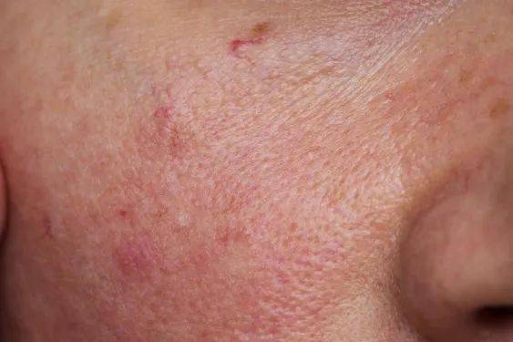 肌肤|傻子才听吴昕的敷三明治面膜！