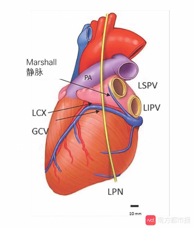 marshall静脉示意图