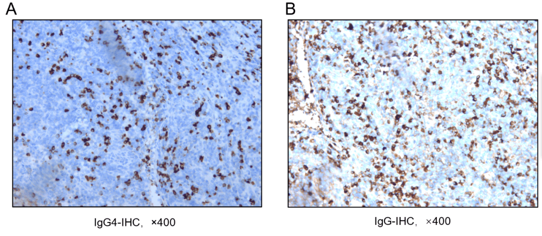 淋巴结|血肌酐升高，腹股沟淋巴结越来越大，一查竟是......